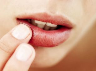 Lip-Infections-And-Their-Cures