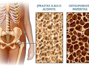 osteoporoze